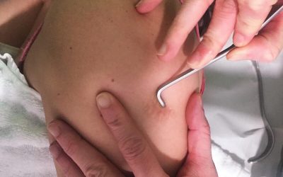 FIBROLISIS DIACUTÁNEA